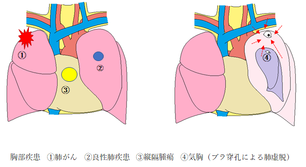 胸部疾患①肺がん、②良性肺疾患、③縦隔腫瘍、④気胸(ブラ穿孔による肺虚脱)の図